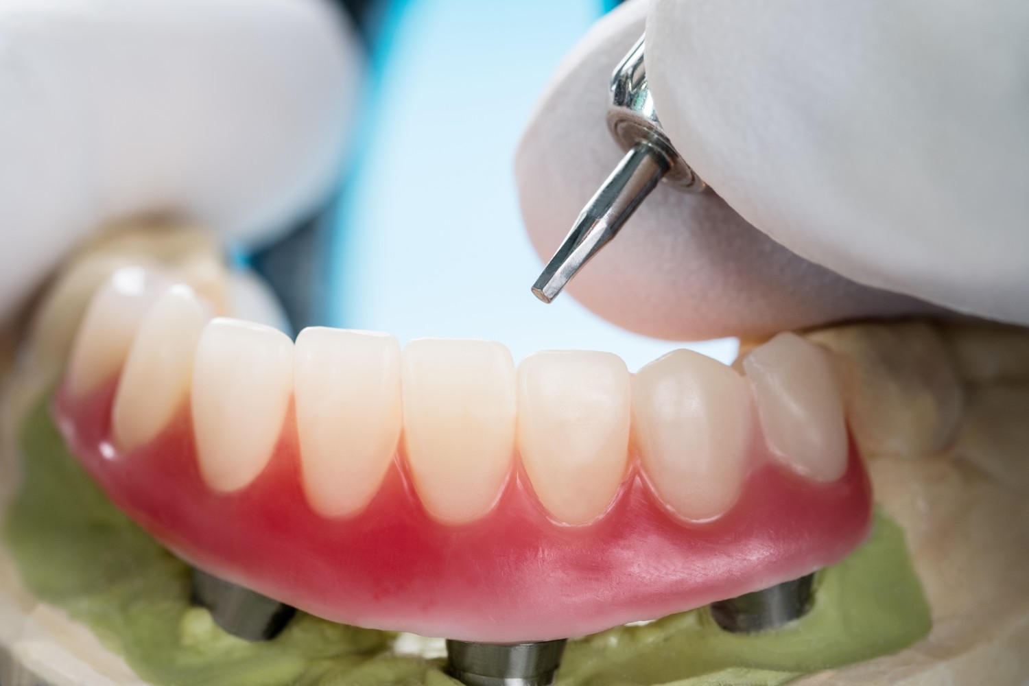植牙引發的牙周病治療費用該由消費者